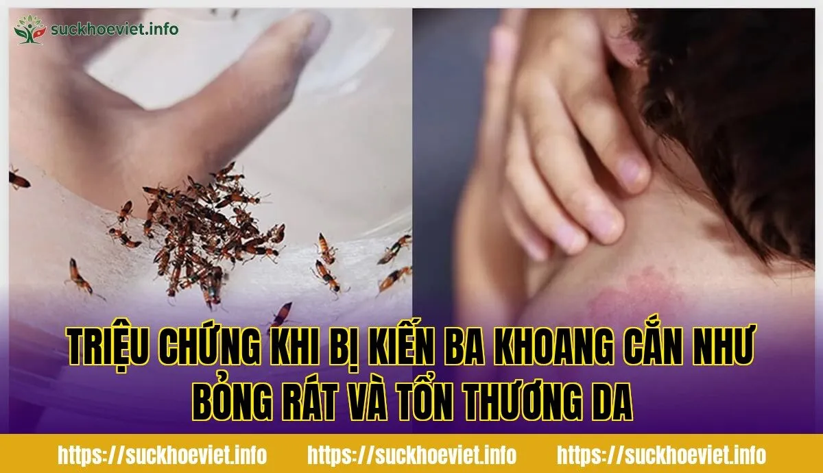 triệu chứng khi bị kiến ba khoang cắn như bỏng rát và tổn thương da