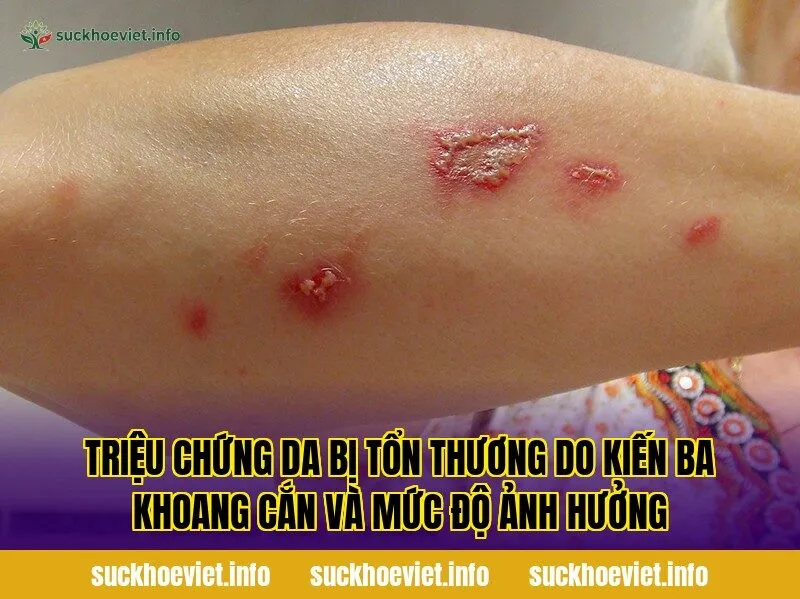 Triệu chứng da bị tổn thương do kiến ba khoang cắn và mức độ ảnh hưởng