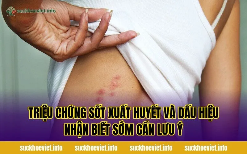 Triệu chứng sốt xuất huyết và dấu hiệu nhận biết sớm cần lưu ý