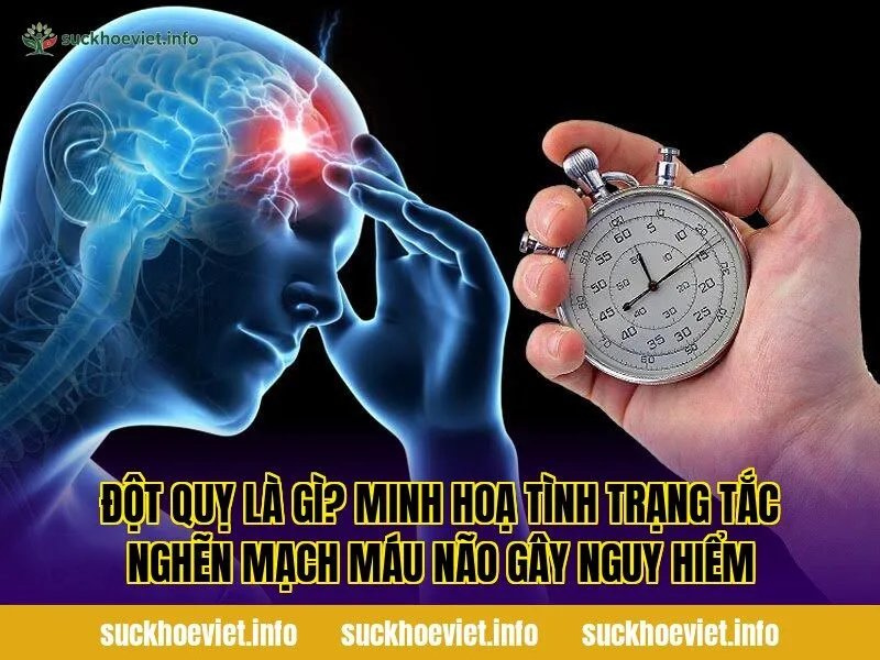 Đột quỵ là gì? Minh hoạ tình trạng tắc nghẽn mạch máu não gây nguy hiểm