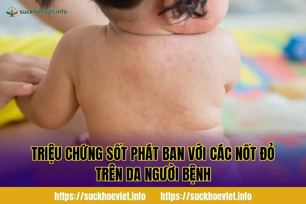Triệu chứng sốt phát ban với các nốt đỏ trên da người bệnh