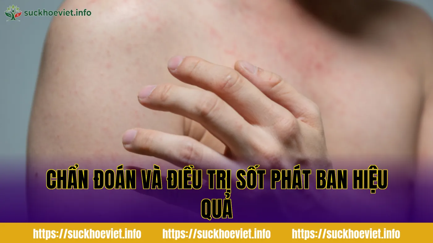 Chẩn đoán và điều trị sốt phát ban hiệu quả
