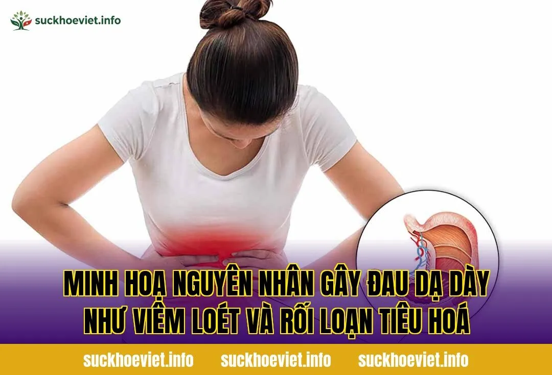 Minh hoạ nguyên nhân gây đau dạ dày như viêm loét và rối loạn tiêu hoá
