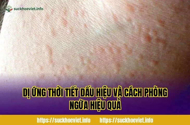 Dị ứng thời tiết dấu hiệu và cách phòng ngừa hiệu quả
