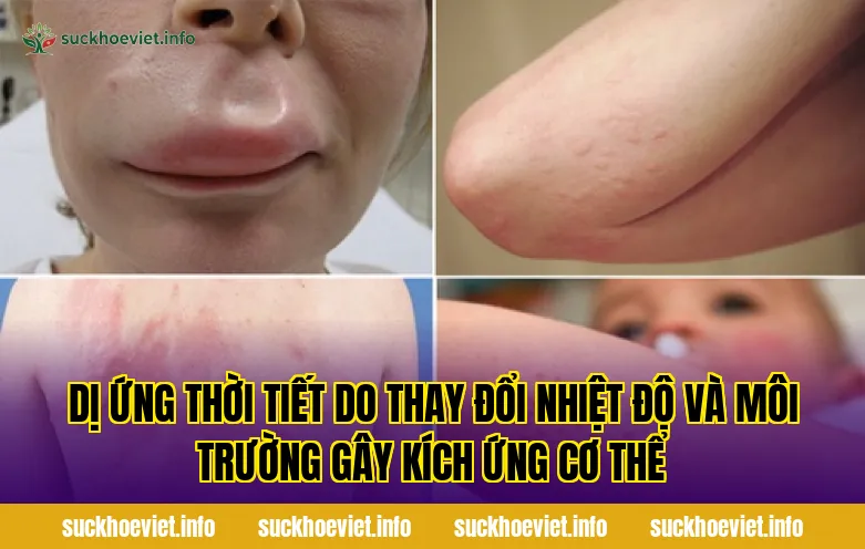 Dị ứng thời tiết do thay đổi nhiệt độ và môi trường gây kích ứng cơ thể