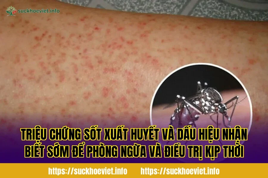 Triệu chứng sốt xuất huyết và dấu hiệu nhận biết sớm để phòng ngừa và điều trị kịp thời