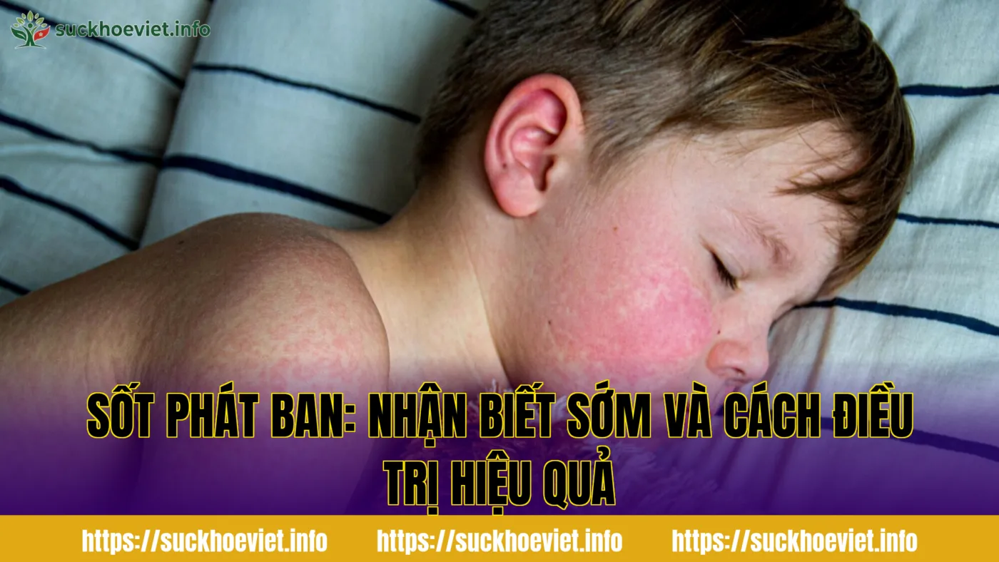 Sốt phát ban: nhận biết sớm và cách điều trị hiệu quả