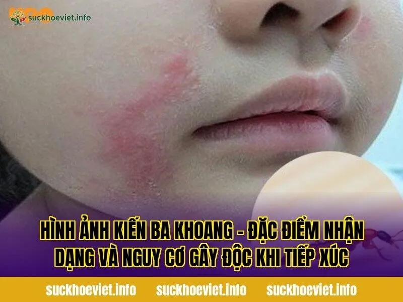 Hình ảnh kiến ba khoang – đặc điểm nhận dạng và nguy cơ gây độc khi tiếp xúc