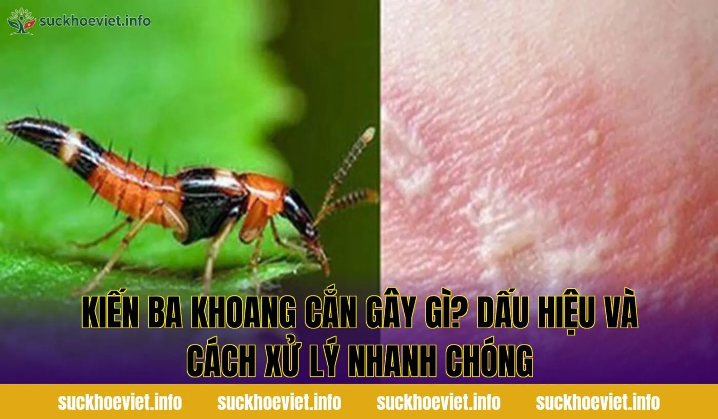 Kiến ba khoang cắn gây gì? Dấu hiệu và cách xử lý nhanh chóng