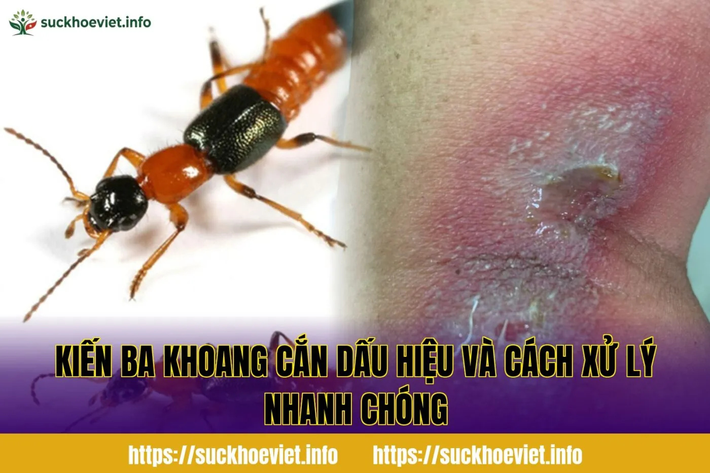 Kiến ba khoang cắn dấu hiệu và cách xử lý nhanh chóng