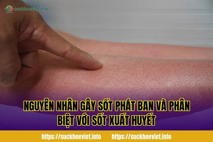Nguyên nhân gây sốt phát ban và phân biệt với sốt xuất huyết