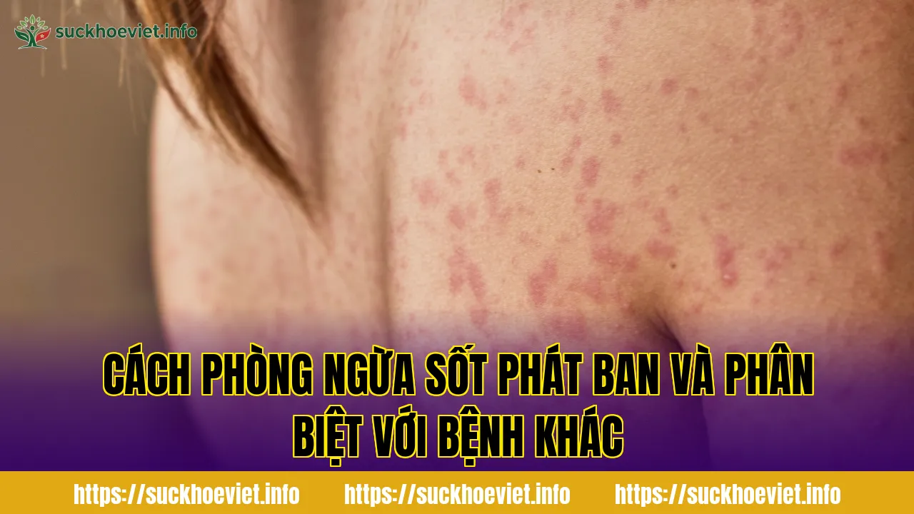 Cách phòng ngừa sốt phát ban và phân biệt với bệnh khác