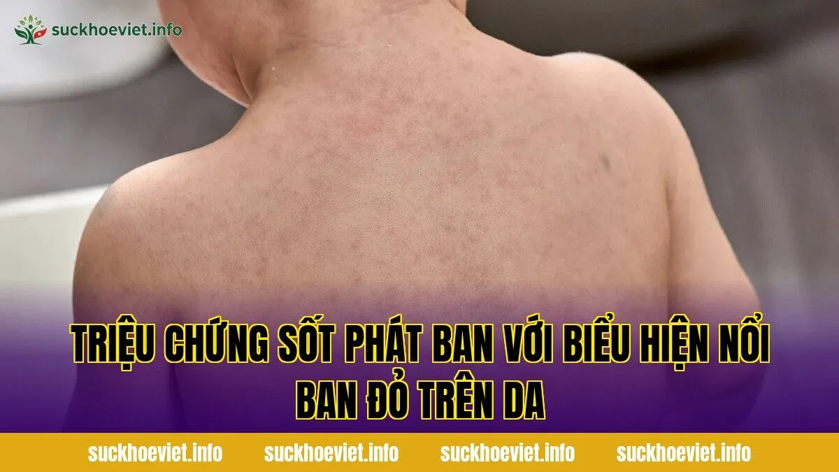 Triệu chứng sốt phát ban với biểu hiện nổi ban đỏ trên da