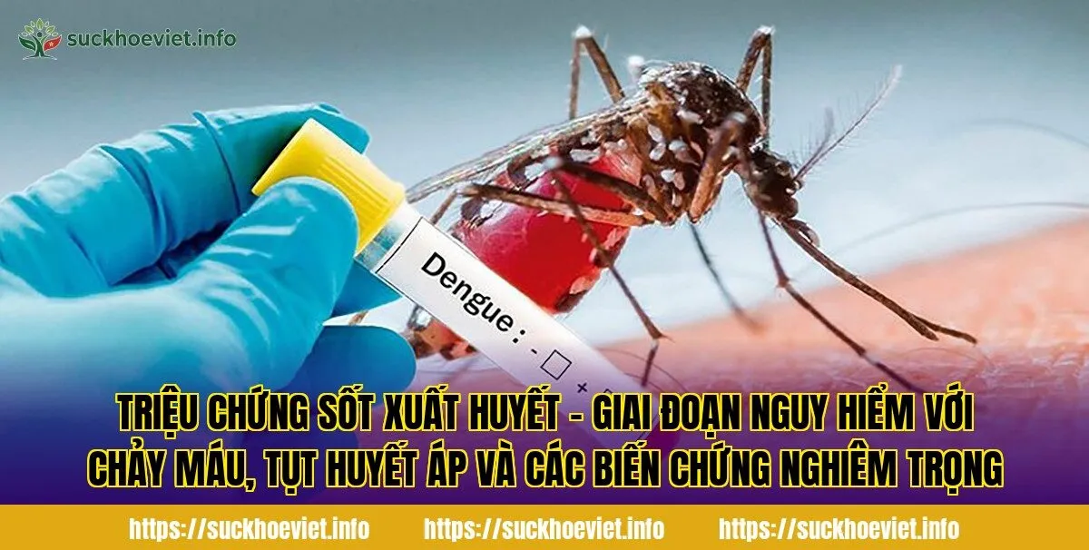 Triệu chứng sốt xuất huyết - Giai đoạn nguy hiểm với chảy máu, tụt huyết áp và các biến chứng nghiêm trọng