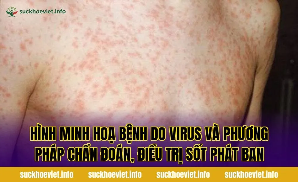 Hình minh hoạ bệnh do virus và phương pháp chẩn đoán, điều trị sốt phát ban