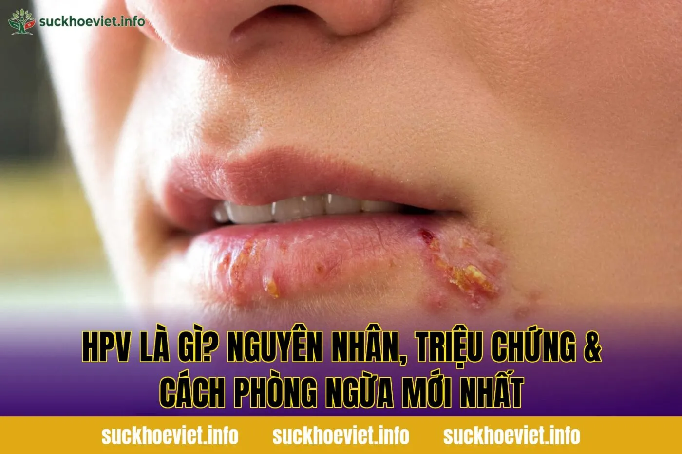 HPV là gì? Nguyên nhân, triệu chứng & cách phòng ngừa mới nhất