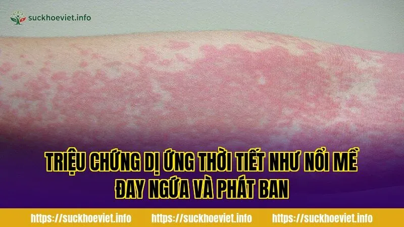 triệu chứng dị ứng thời tiết như nổi mề đay ngứa và phát ban