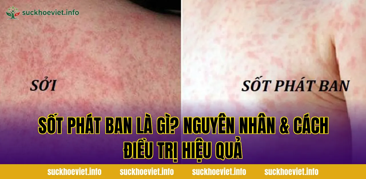 Sốt phát ban là gì? Nguyên nhân & cách điều trị hiệu quả