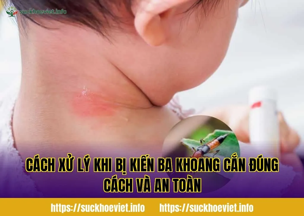 cách xử lý khi bị kiến ba khoang cắn đúng cách và an toàn