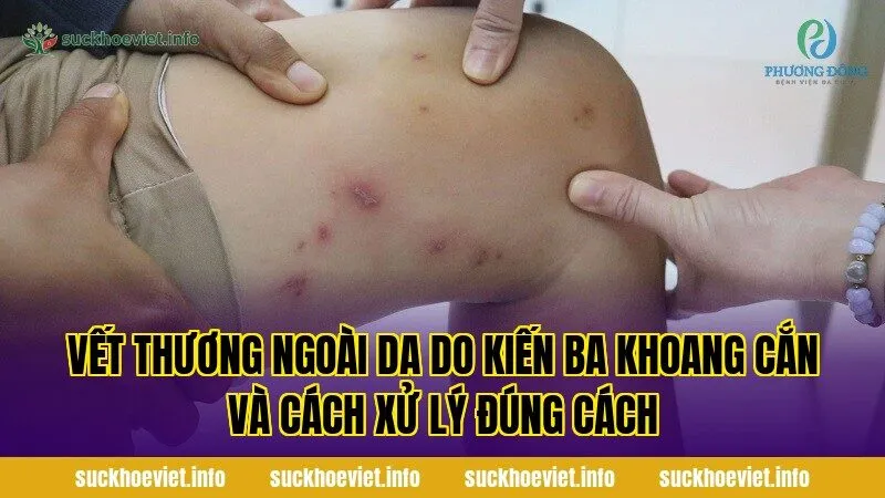 Vết thương ngoài da do kiến ba khoang cắn và cách xử lý đúng cách