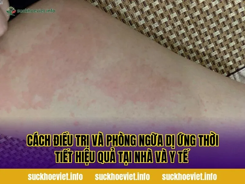 Cách điều trị và phòng ngừa dị ứng thời tiết hiệu quả tại nhà và y tế