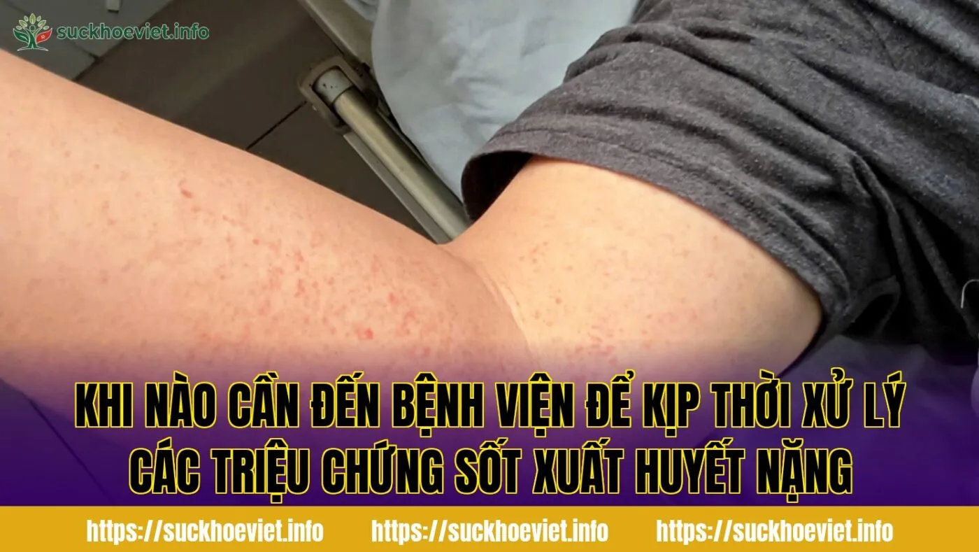 Khi nào cần đến bệnh viện để kịp thời xử lý các triệu chứng sốt xuất huyết nặng