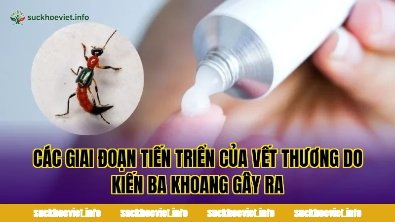 Các giai đoạn tiến triển của vết thương do kiến ba khoang gây ra