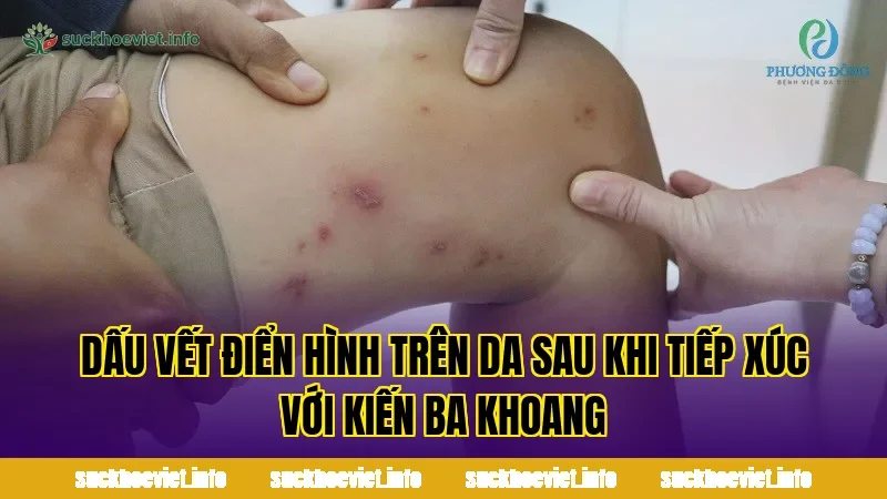 Dấu vết điển hình trên da sau khi tiếp xúc với kiến ba khoang
