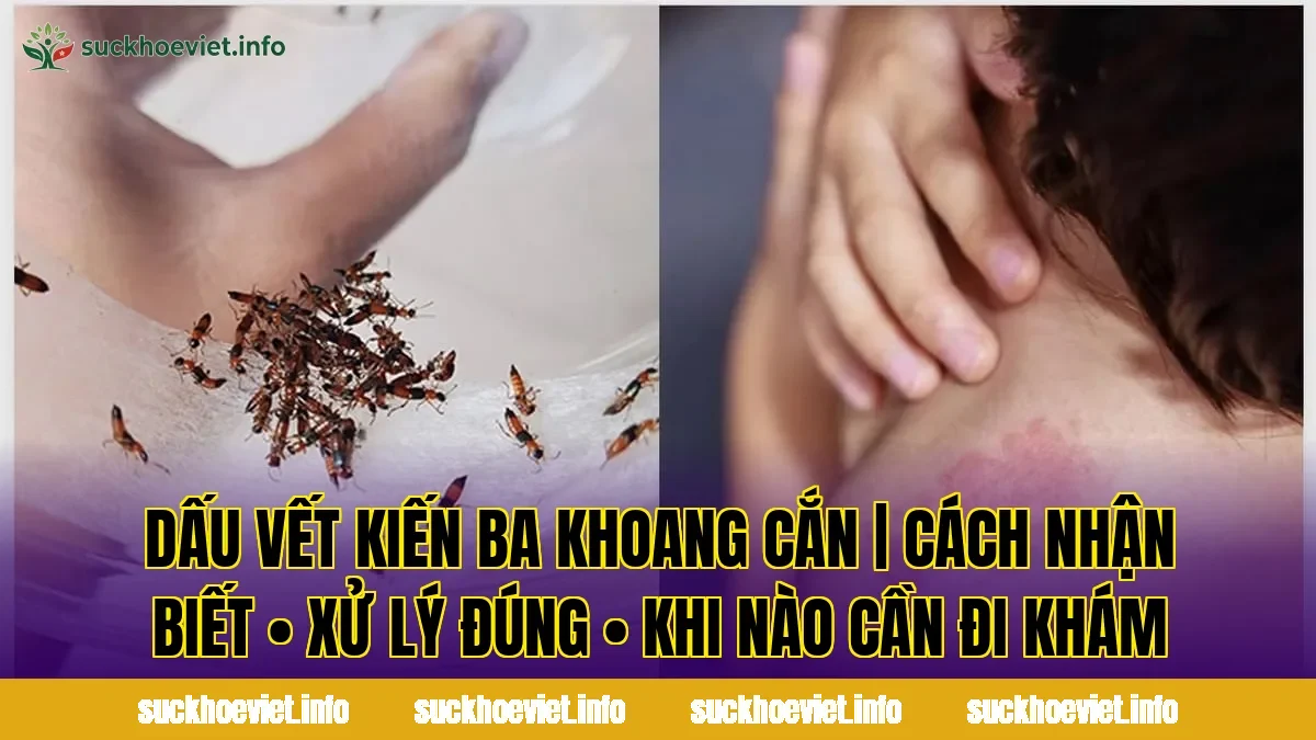 DẤU VẾT KIẾN BA KHOANG CẮN | CÁCH NHẬN BIẾT • XỬ LÝ ĐÚNG • KHI NÀO CẦN ĐI KHÁM