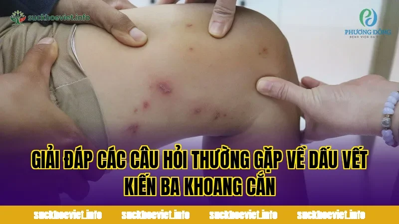 Giải đáp các câu hỏi thường gặp về dấu vết kiến ba khoang cắn
