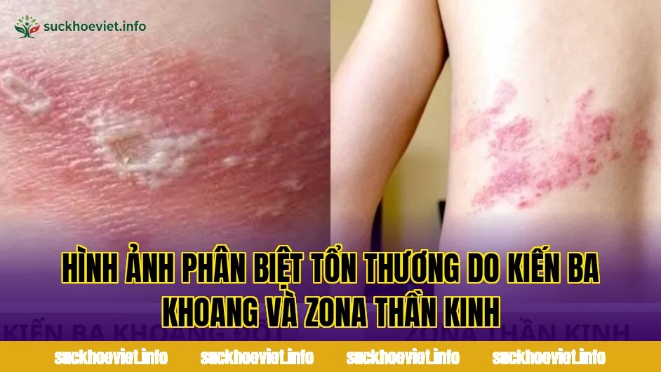 Hình ảnh phân biệt tổn thương do kiến ba khoang và zona thần kinh