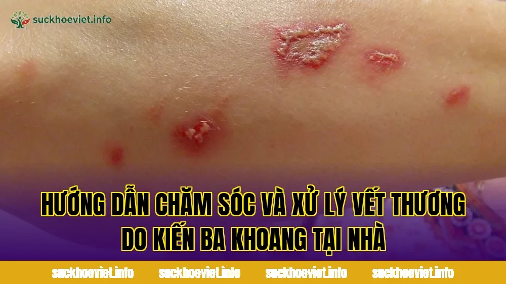 Hướng dẫn chăm sóc và xử lý vết thương do kiến ba khoang tại nhà
