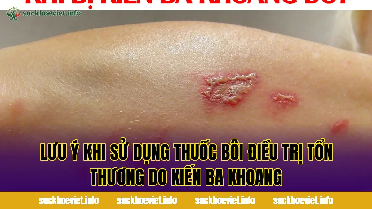 Lưu ý khi sử dụng thuốc bôi điều trị tổn thương do kiến ba khoang