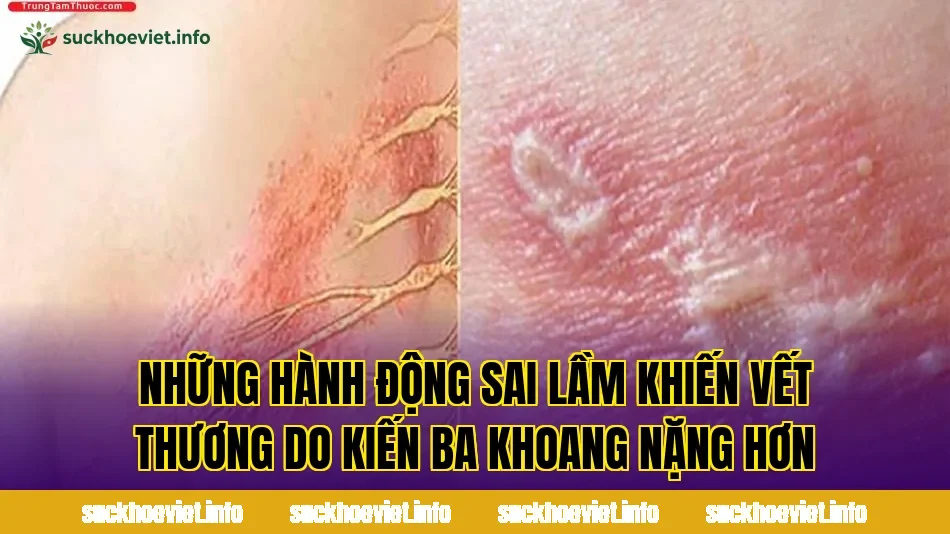 Những hành động sai lầm khiến vết thương do kiến ba khoang nặng hơn