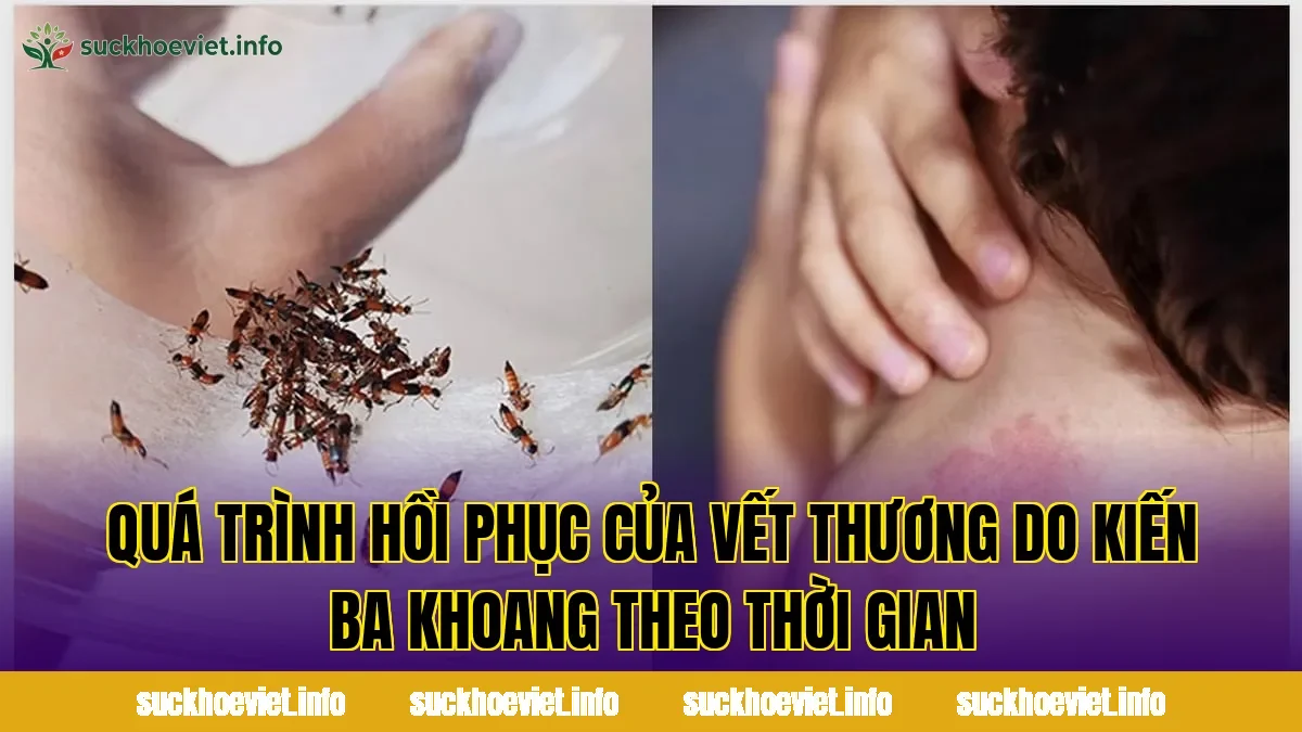 Quá trình hồi phục của vết thương do kiến ba khoang theo thời gian