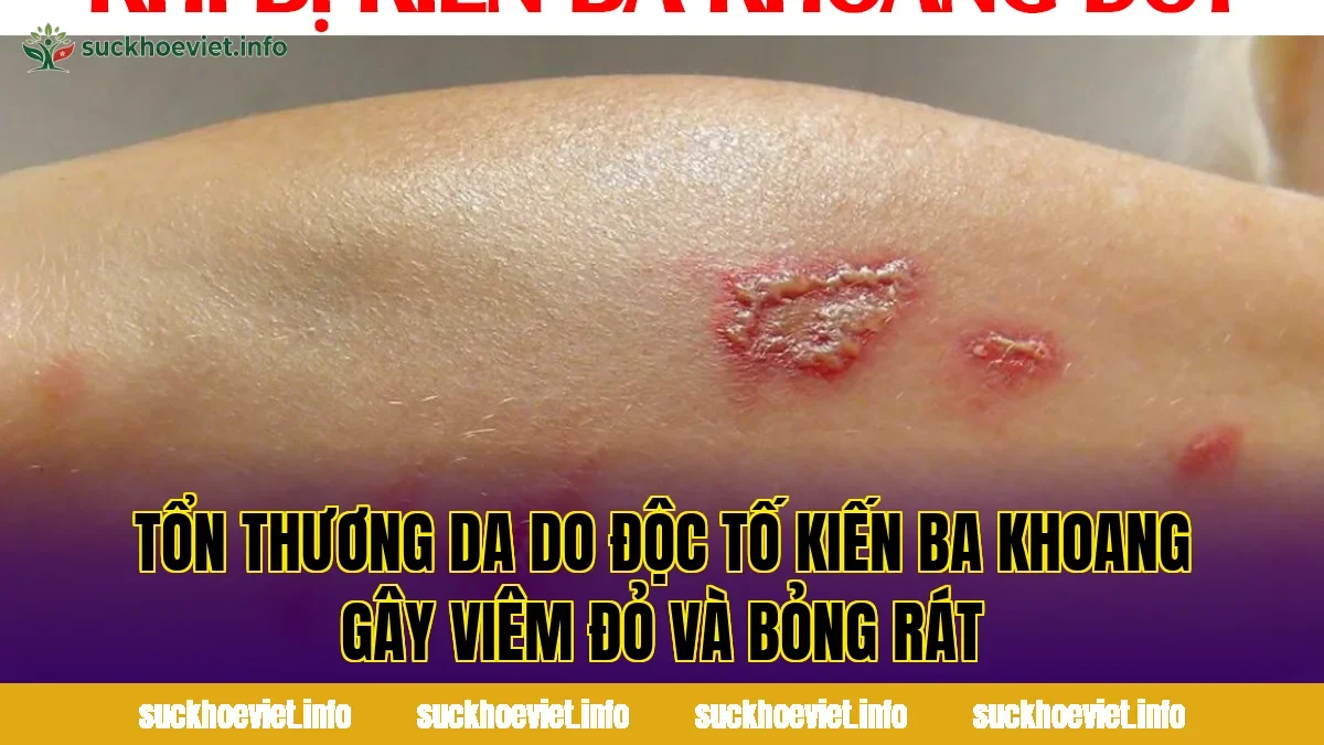 Tổn thương da do độc tố kiến ba khoang gây viêm đỏ và bỏng rát
