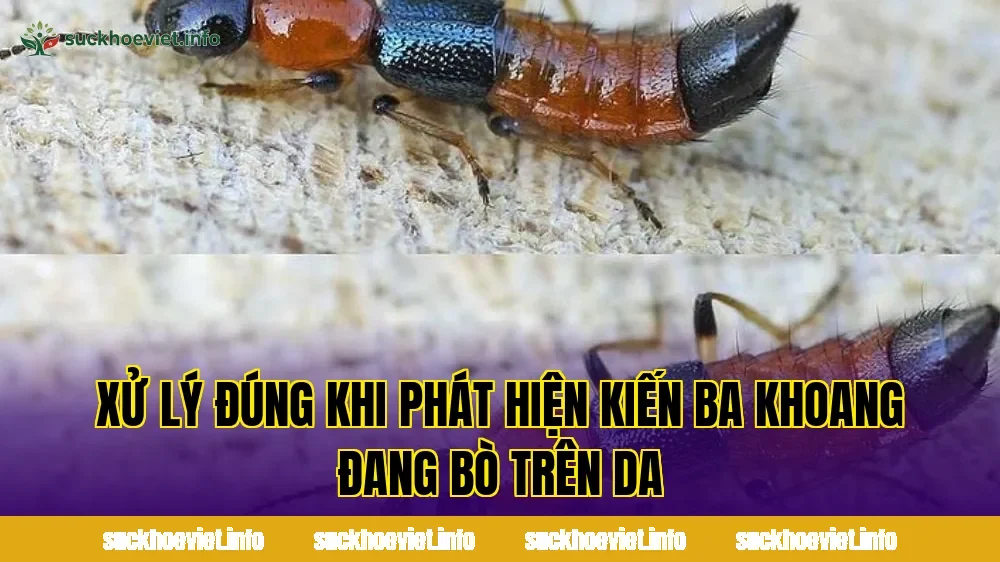 Xử lý đúng khi phát hiện kiến ba khoang đang bò trên da