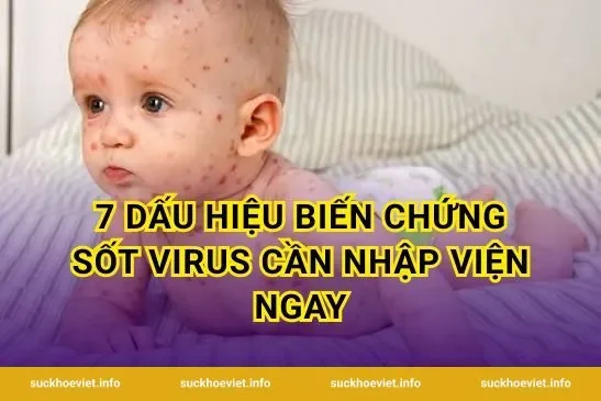 7 Dấu Hiệu Biến Chứng Sốt Virus Cần Nhập Viện Ngay