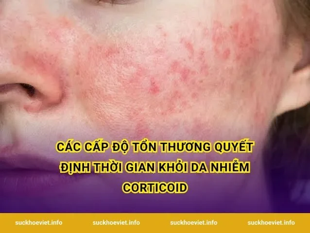 Các cấp độ tổn thương quyết định thời gian khỏi da nhiễm corticoid
