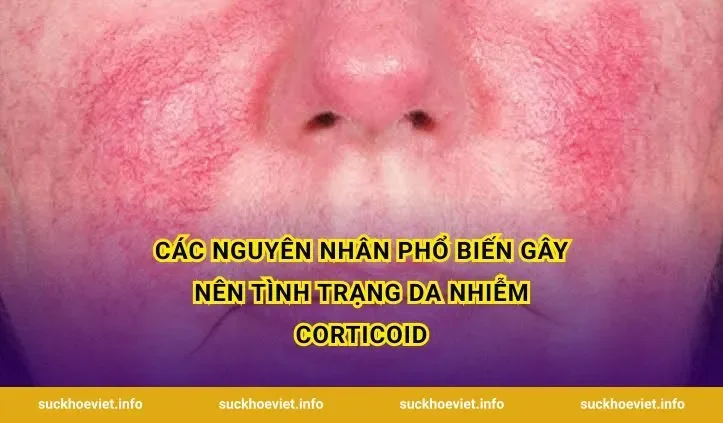 Các nguyên nhân phổ biến gây nên tình trạng da nhiễm corticoid
