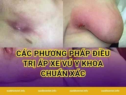 Các phương pháp điều trị áp xe vú y khoa chuẩn xác