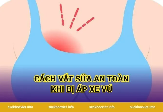 Cách Vắt Sữa An Toàn Khi Bị Áp Xe Vú