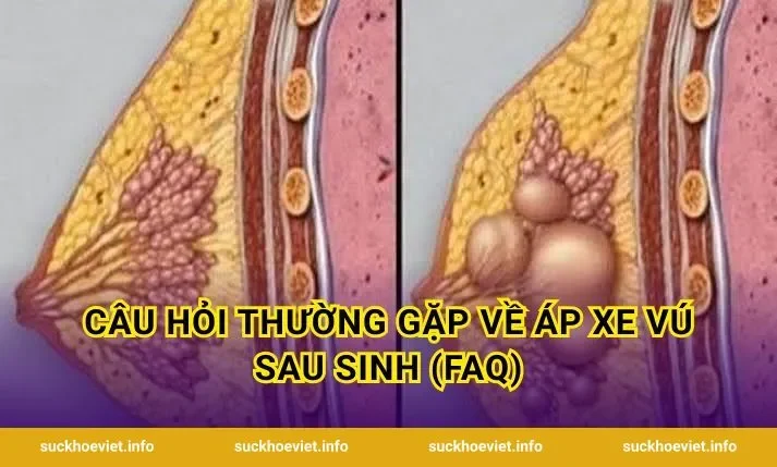 Câu hỏi thường gặp về áp xe vú sau sinh (FAQ)