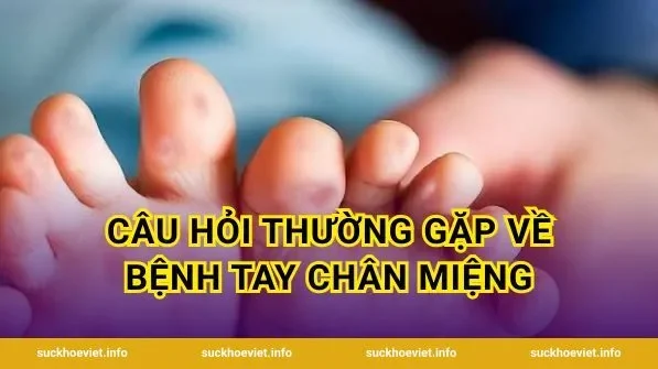 Câu hỏi thường gặp về bệnh tay chân miệng