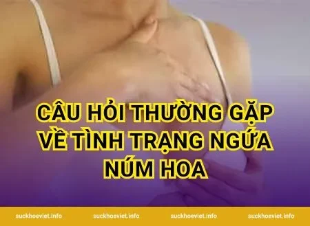 Câu hỏi thường gặp về tình trạng ngứa núm hoa