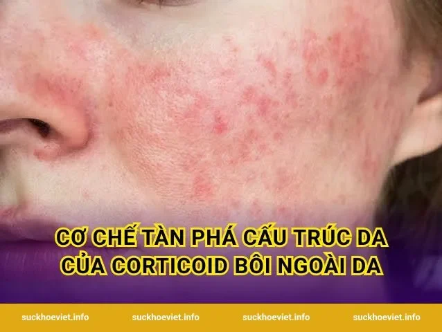 Cơ chế tàn phá cấu trúc da của corticoid bôi ngoài da