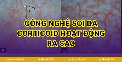 Công Nghệ Soi Da Corticoid Hoạt Động Ra Sao