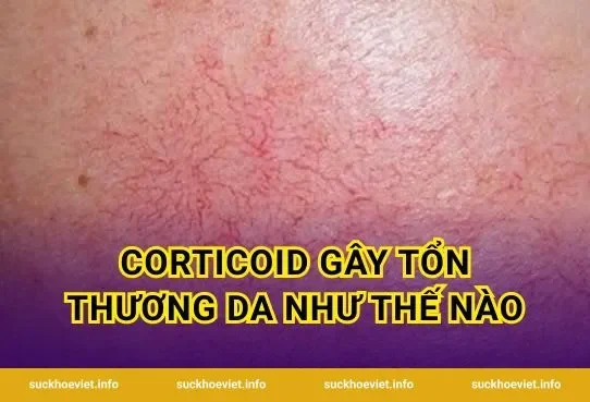 Corticoid Gây Tổn Thương Da Như Thế Nào