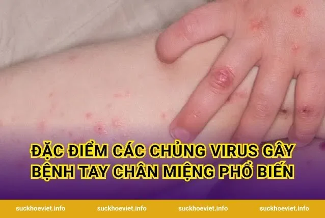 Đặc điểm các chủng virus gây bệnh tay chân miệng phổ biến