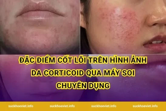 Đặc Điểm Cốt Lõi Trên hình ảnh da corticoid Qua Máy Soi Chuyên Dụng